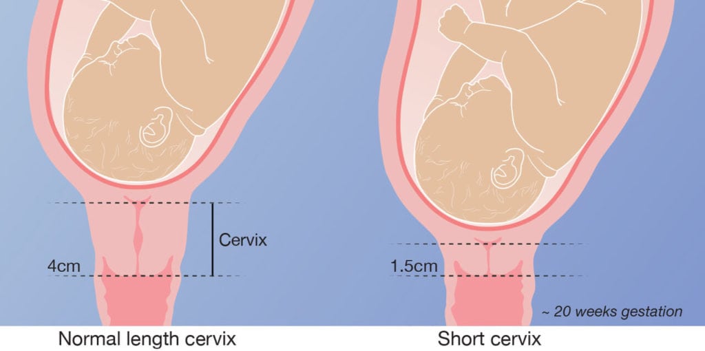 Shortening of the cervix Battista Illustration