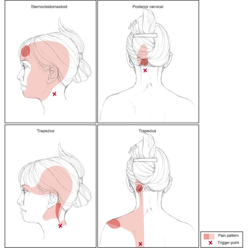 Head and neck trigger points, 1° and 2° pain patterns | Battista