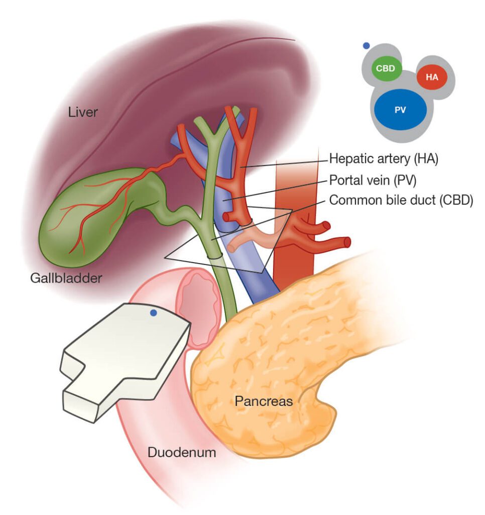 Hepatic triad visualized with ultrasound | Battista Illustration